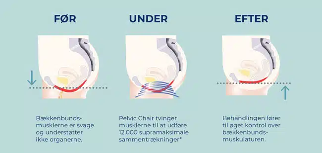 Pelvic chair before after